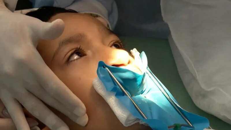 LEI GARANTE CIRURGIA E TRATAMENTO COMPLETO DE LÁBIO LEPORINO PELO SUS