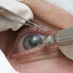 CIRURGIA PARA MUDAR COR DOS OLHOS É INDICADA APENAS PARA PESSOAS CEGAS, ALERTA CBO