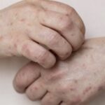 VIGILÂNCIA DA BAHIA INVESTIGA SUSPEITA DE MPOX EM IRECÊ